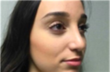 Rhinoplasty After Photo by Mariam Awada, MD, FACS; ,  - Case 40233
