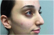 Rhinoplasty Before Photo by Mariam Awada, MD, FACS; ,  - Case 40233