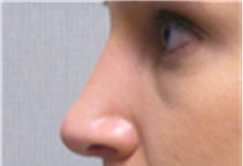 Rhinoplasty After Photo by Mariam Awada, MD, FACS; ,  - Case 40246