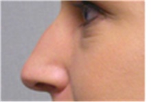 Rhinoplasty Before Photo by Mariam Awada, MD, FACS; ,  - Case 40246