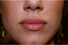 Dermal Fillers After Photo by Mariam Awada, MD, FACS; ,  - Case 40254