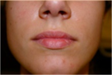 Dermal Fillers Before Photo by Mariam Awada, MD, FACS; ,  - Case 40254