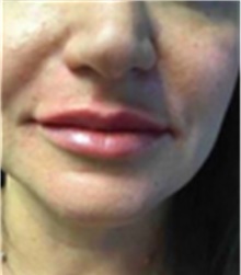 Dermal Fillers After Photo by Mariam Awada, MD, FACS; ,  - Case 40255