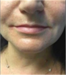Dermal Fillers Before Photo by Mariam Awada, MD, FACS; ,  - Case 40255