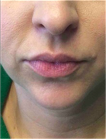 Dermal Fillers Before Photo by Mariam Awada, MD, FACS; ,  - Case 40256