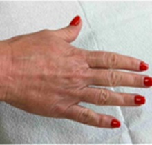 Dermal Fillers After Photo by Mariam Awada, MD, FACS; ,  - Case 40260