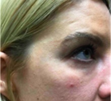 Dermal Fillers After Photo by Mariam Awada, MD, FACS; ,  - Case 40265