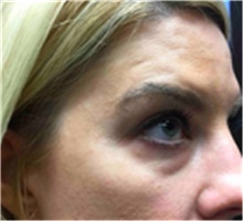 Dermal Fillers Before Photo by Mariam Awada, MD, FACS; ,  - Case 40265