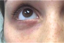 Dermal Fillers After Photo by Mariam Awada, MD, FACS; ,  - Case 40267