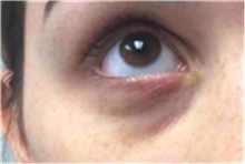 Dermal Fillers Before Photo by Mariam Awada, MD, FACS; ,  - Case 40267