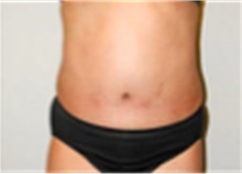 Tummy Tuck After Photo by Mariam Awada, MD, FACS; ,  - Case 40331