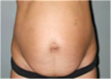 Tummy Tuck Before Photo by Mariam Awada, MD, FACS; ,  - Case 40331