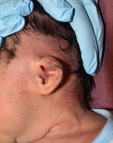 Ear Surgery Before Photo by Rachel Ruotolo, MD; Garden City, NY - Case 40738