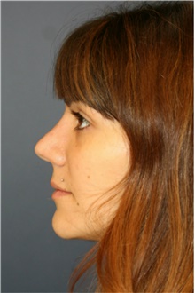 Rhinoplasty After Photo by Steve Laverson, MD, FACS; Rancho Santa Fe, CA - Case 40956