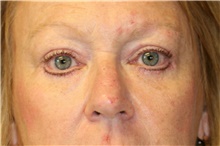Eyelid Surgery After Photo by Steve Laverson, MD, FACS; Rancho Santa Fe, CA - Case 41329