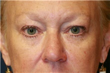 Eyelid Surgery Before Photo by Steve Laverson, MD, FACS; Rancho Santa Fe, CA - Case 41329