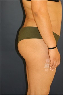 Buttock Lift with Augmentation After Photo by Steve Laverson, MD, FACS; Rancho Santa Fe, CA - Case 41351