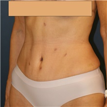 Tummy Tuck After Photo by Steve Laverson, MD, FACS; Rancho Santa Fe, CA - Case 41352