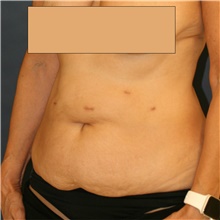 Tummy Tuck Before Photo by Steve Laverson, MD, FACS; Rancho Santa Fe, CA - Case 41352