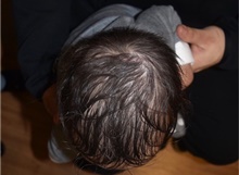 Craniosynostosis After Photo by Rachel Ruotolo, MD; Garden City, NY - Case 41353