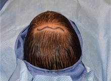 Craniosynostosis Before Photo by Rachel Ruotolo, MD; Garden City, NY - Case 41353