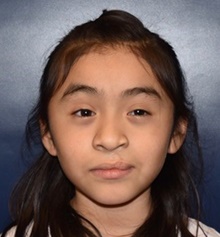 Cleft Lip and Palate Repair After Photo by Rachel Ruotolo, MD; Garden City, NY - Case 41369