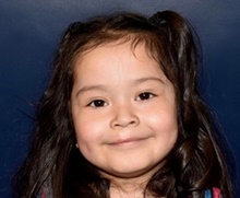 Cleft Lip and Palate Repair After Photo by Rachel Ruotolo, MD; Garden City, NY - Case 41373