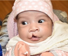Cleft Lip and Palate Repair Before Photo by Rachel Ruotolo, MD; Garden City, NY - Case 41373