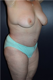 Tummy Tuck After Photo by Larry Weinstein, MD; Chester, NJ - Case 41605