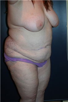 Tummy Tuck Before Photo by Larry Weinstein, MD; Chester, NJ - Case 41605