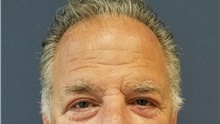 Eyelid Surgery After Photo by Noel Natoli, MD, FACS; East Hills, NY - Case 41911