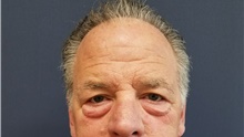Eyelid Surgery Before Photo by Noel Natoli, MD, FACS; East Hills, NY - Case 41911