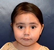 Craniosynostosis After Photo by Rachel Ruotolo, MD; Garden City, NY - Case 41955