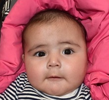 Craniosynostosis Before Photo by Rachel Ruotolo, MD; Garden City, NY - Case 41955