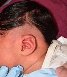Ear Surgery Before Photo by Rachel Ruotolo, MD; Garden City, NY - Case 41964