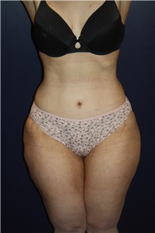 Tummy Tuck After Photo by Larry Weinstein, MD; Chester, NJ - Case 42067