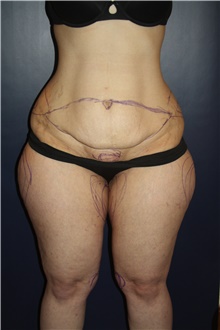 Tummy Tuck Before Photo by Larry Weinstein, MD; Chester, NJ - Case 42067