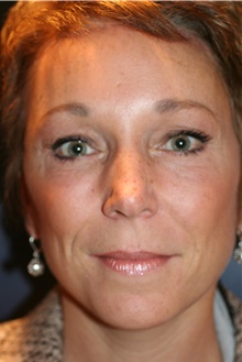 Brow Lift After Photo by Larry Weinstein, MD; Chester, NJ - Case 42097