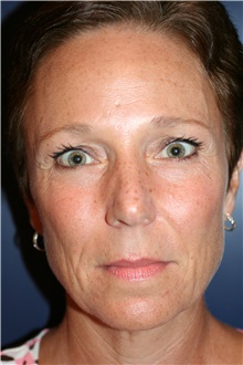 Brow Lift Before Photo by Larry Weinstein, MD; Chester, NJ - Case 42097