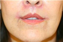 Lip Augmentation/Enhancement After Photo by Steve Laverson, MD, FACS; Rancho Santa Fe, CA - Case 42098