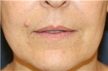 Lip Augmentation/Enhancement Before Photo by Steve Laverson, MD, FACS; Rancho Santa Fe, CA - Case 42098