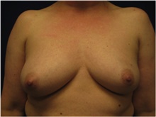Breast Reconstruction Before Photo by Nicholas Leonardi, DO; ,  - Case 42437