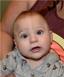 Craniosynostosis Before Photo by Rachel Ruotolo, MD; Garden City, NY - Case 42478
