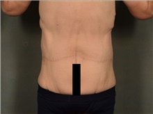 Body Lift After Photo by Ellen Janetzke, MD; Bloomfield Hills, MI - Case 42993