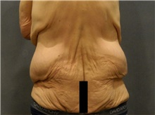 Body Lift Before Photo by Ellen Janetzke, MD; Bloomfield Hills, MI - Case 42993
