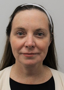 Facelift After Photo by Sara Dickie, MD; ,  - Case 43156