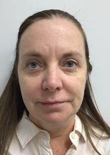 Facelift Before Photo by Sara Dickie, MD; ,  - Case 43156