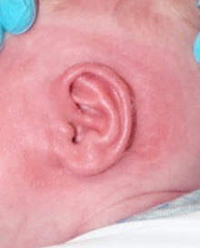 Ear Surgery After Photo by Rachel Ruotolo, MD; Garden City, NY - Case 43373