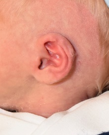 Ear Surgery Before Photo by Rachel Ruotolo, MD; Garden City, NY - Case 43373