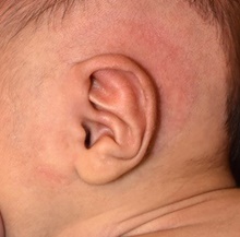 Ear Surgery After Photo by Rachel Ruotolo, MD; Garden City, NY - Case 43377
